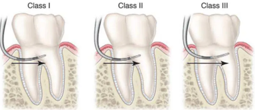 Figura 4 – Classificação de Hamp. Adaptado de (Sturdevant's Art &amp; Science of Operative Dentistry,  2002)