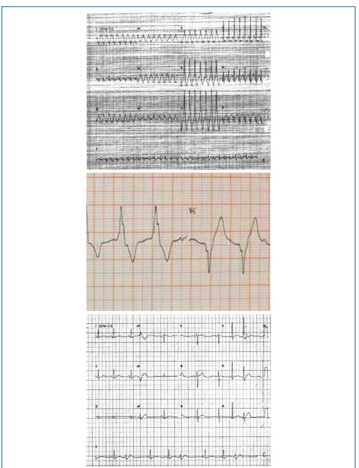 Figure 1 - A - Sustained monomorphic ventricular tachycardia. B - Accelerated idioventricular rhythm