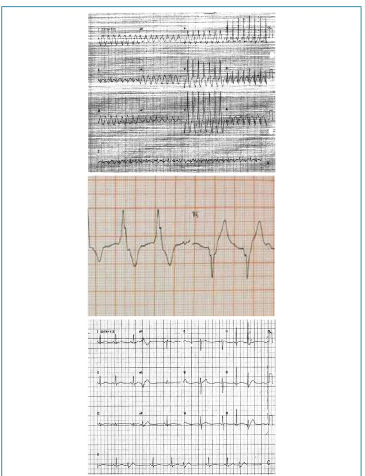 Figure 1 - A - Sustained monomorphic ventricular tachycardia. B - Accelerated idioventricular rhythm