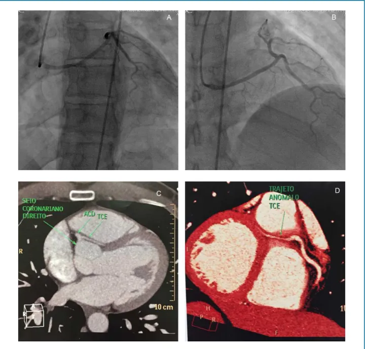 Figure 2 - A, B, C - Images showing the left coronary artery anomalous origin, from the right coronary artery