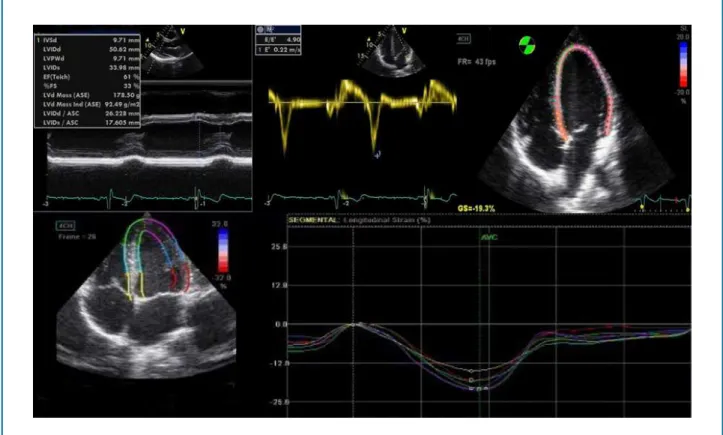 Figure 1 - Heart with left ventricular parietal thickness and dimension within limits considered to be normal, with supranormal  values of diastolic function and normal global longitudinal strain.