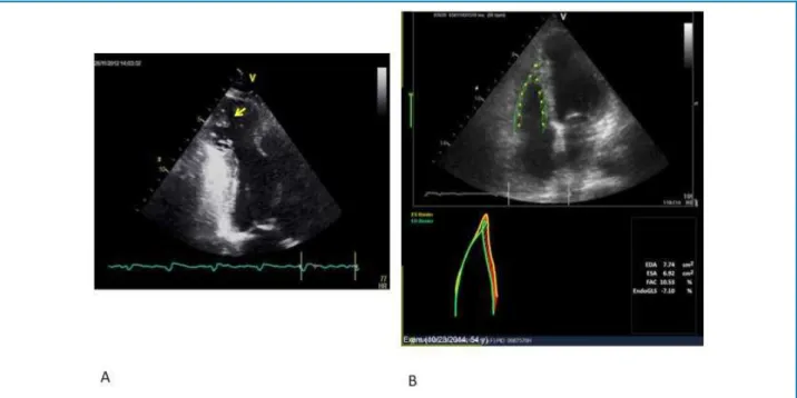 Figura 3 – Painel A: Imagem ecocardiográfica da projeção apical 2-câmaras de ventrículo esquerdo evidencia grande aneurisma apical preenchido  por imagem sugestiva de trombo (seta amarela)