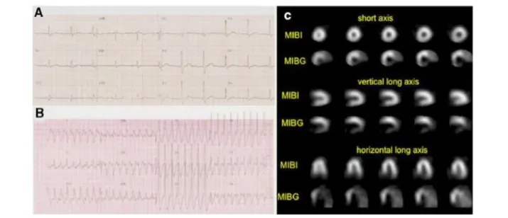 Figure 4 – Illustrative example of patients with CCC, presenting Sustained Ventricular Tachycardia (SVT, documented on the ECG of image B)  and presenting uptake defect in the inferior and posterolateral walls in the 123-I MIBG SPECT images (image C)
