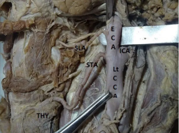 Figure 3. Origin of right superior thyroid artery from common  carotid bifurcation. Rt CCA = right common carotid artery; 