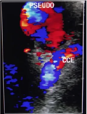 Figura 3. Esternotomia com extensão supraclavicular direita.