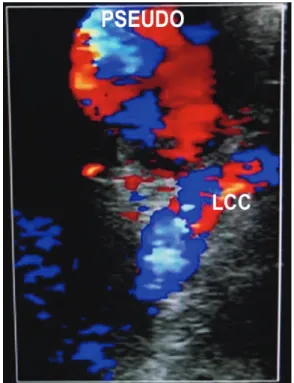 Figure 3. Sternotomy with right supraclavicular extension.