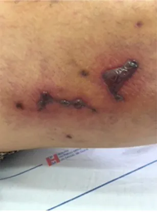 Figure 4. Development of scabs into necrosis by 33rd day after  esthetic sclerotherapy for telangiectasias of the lower limbs using  hypertonic glucose (75%).