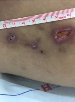Figure 6. Topical preparation comprising 60% glucose + 40% 