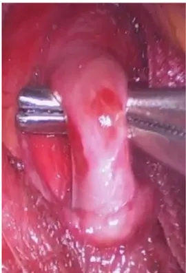 Figura 2. Liberação da compressão do tronco celíaco através da  secção do ligamento arqueado por videolaparoscopia.