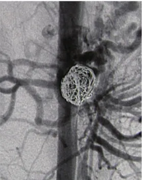 Figura 3. Eco-Doppler realizado após a secção do ligamento  arqueado mostrando a ausência de compressão do tronco  celíaco, restando apenas uma estenose residual com dilatação  pós-estenótica
