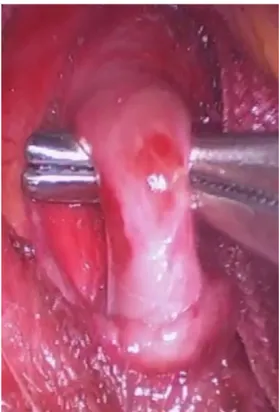 Figure 2. Relieving compression of the celiac trunk by sectioning  the arcuate ligament via videolaparoscopy.