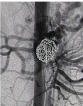 Figure 3. Doppler ultrasonography conducted after sectioning  the arcuate ligament, showing absence of compression of the  celiac trunk, leaving only residual stenosis with post-stenotic  dilation