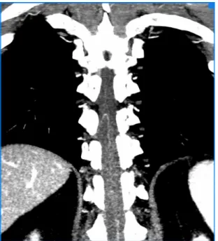 Figure 4. Final result of the methodology employed for  identification of the AKA, angular angiotomography slice of  the spinal space, showing the AKA.