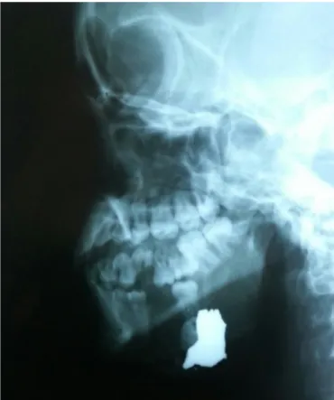 Figure 1. Lateral oblique radiograph evidencing comminuted fracture of the man- man-dibular body with displaced teeth and retention of foreign body consistent  with firearm projectile