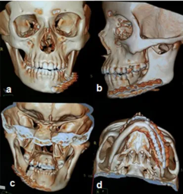 Figure 6. Through the whistling movement, the disappearance of neuropraxia in late  post-op can be noted.