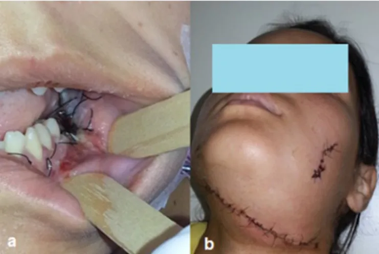 Figure 7. a) Intraoral appearance after 7 days; b) View of submandibular access after  7 days.