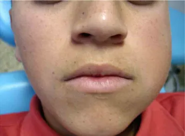 Figure 1. 13-year-old male patient with diffuse tumefaction in the left-side region  of the mandibular body and angle, causing asymmetry of the face,  non-painful and firm on palpation.