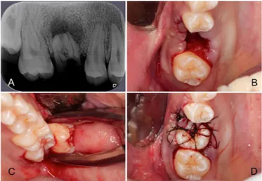Figure 1. A) Radiographic image: note the extensive coronal destruction of tooth  16, and associated periapical lesion; B) Transoperative Image: Extraction  of tooth16; C) Transoperative Image: Extraction of tooth 28 (14 days  af-ter the first procedure); 