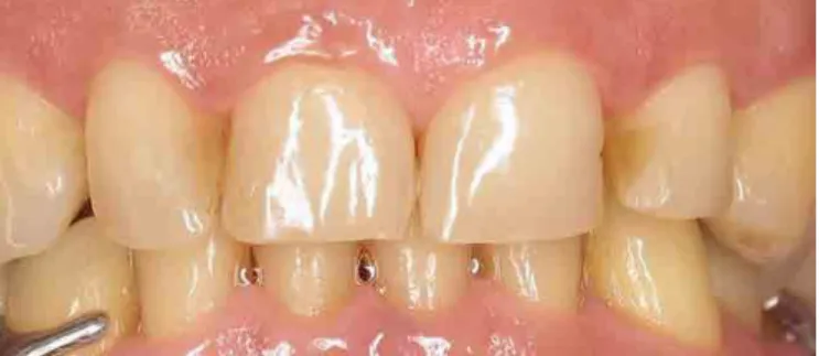 Figure 10. Palatal view after dentist-supervised at-home bleaching with trays and  carbamide peroxide 10%