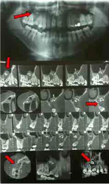 Figure 1. Panoramic radiograph and computed tomograph in lateral and axial cuts: 