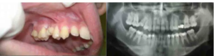 Figure 5. A) clinical aspect in post-operative period at 30 days; b) radiographic  aspect in post-operative period at 30 days.