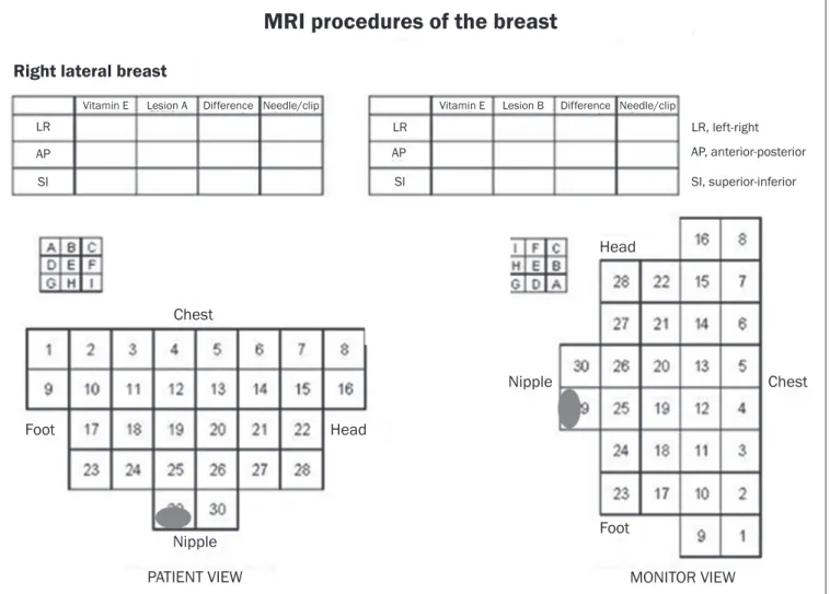 Figure 2. Schematic diagram used in order to guide the biopsy: in this case, lateral access to the right breast will be used.
