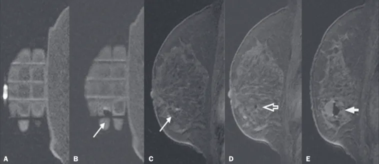 Figure 3. Sagittal fat-suppressed T1-weighted MRI scan of a 53-year-old woman submitted to vacuum-assisted biopsy (approach: left breast, lateral)