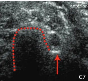 Figure 2. Ultrasound showing the C6 root (arrow), as well as the anterior and posterior tubercles of the transverse process (in yellow and red, respectively).