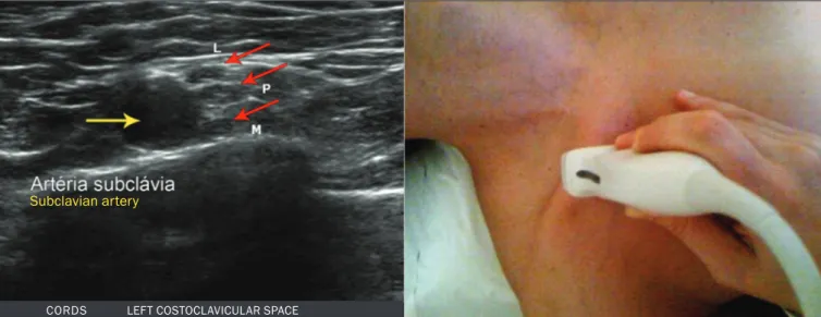 Figure 6. Ultrasound of the retropectoralis minor space with the transducer in the transversal plane showing the medial (M), lateral (L), and posterior (P) cords  (yellow arrows).