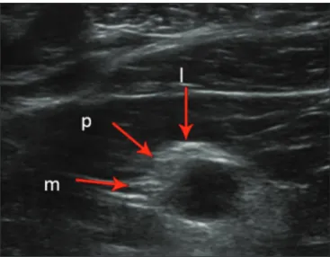 Figure 7. A: Ultrasound in the longitudinal plane showing the C7 root/middle trunk (arrows) in the interscalene space—visualization score of 2