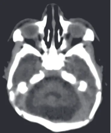 Figure 1.  Non-contrast-enhanced CT images of the brain. Calcification patterns at the cortico-subcortical junction: punctate ( A,B) and coarse (C,D)