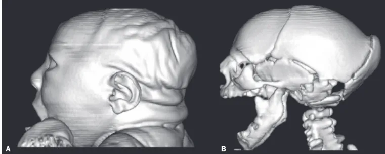 Figure 3. Three-dimensional reconstruction of head CT. A: Severe microcephaly with scalp folds