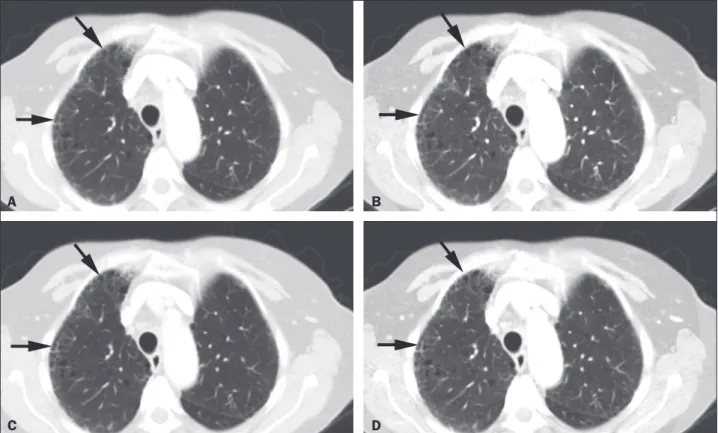Figure 2. Transverse contrast-enhanced DECT images of a 73 year-old-female (BMI = 23.4 kg/m 2 ) who was referred for staging of lung cancer