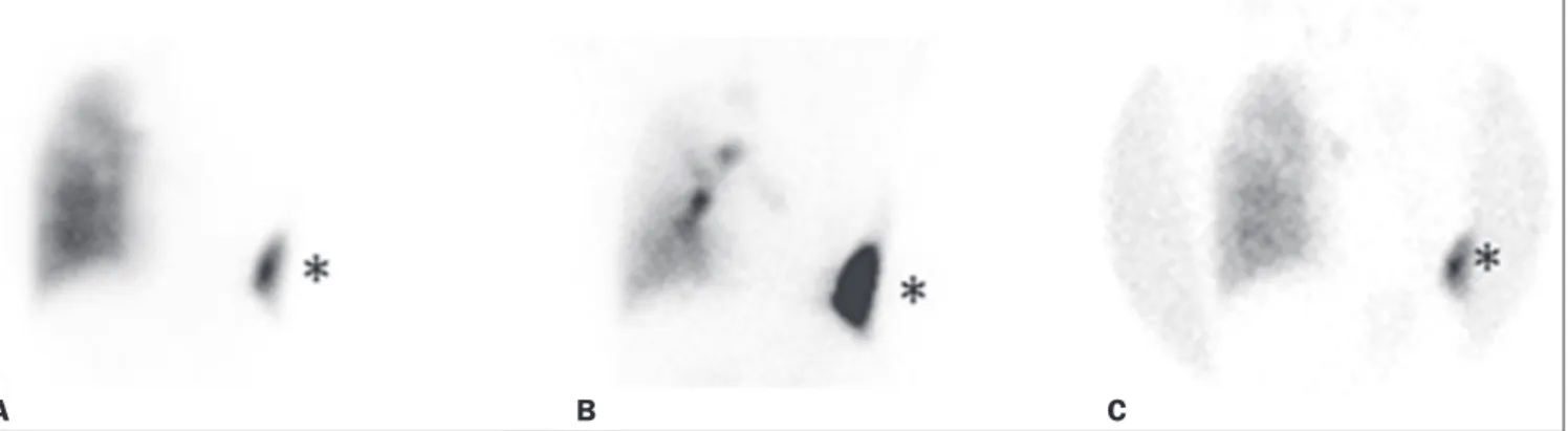Figure 2. Patient submitted to left pneumonectomy and inhalation-perfusion scintigraphy
