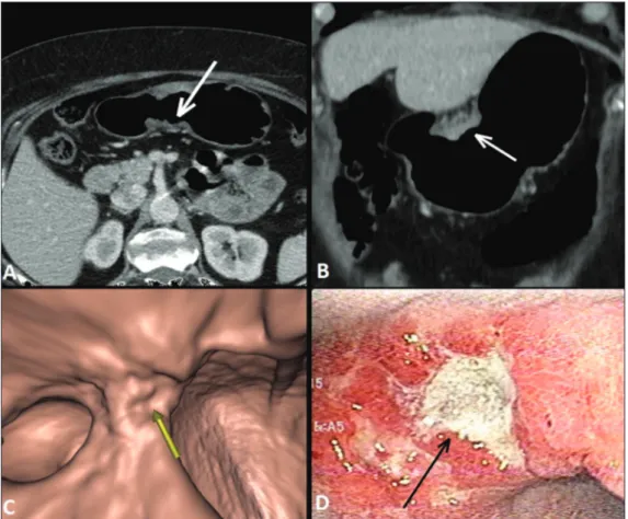 Figure 2. A,B,C: Axial MDCT scan,  coronal MDCT scan, and VG study  (yellow arrow), showing an ulcerated  lesion at the incisura angularis  (ar-rows)