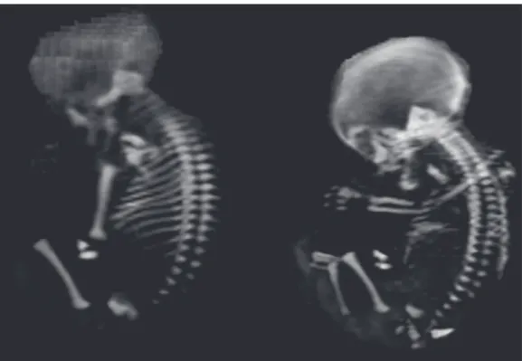 Figure 1. Fetus at 27 weeks of  gestation. Evaluation of a skeleton  after VRT 3D reconstruction.