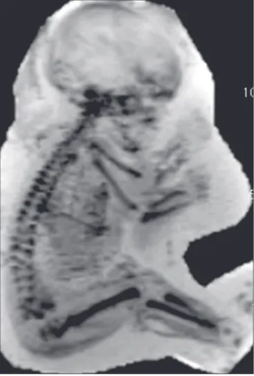 Figure 4. Fetus at 28 weeks of  gestation. Image reformatting with  MinIP and 3D VRT.
