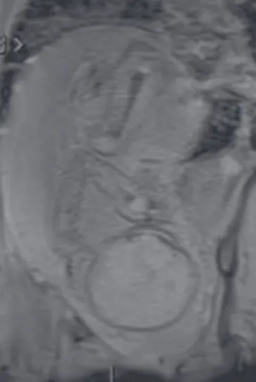 Figure 5.  Fetus at 33 weeks of gestation. Sagittal modified VIBE sequence.