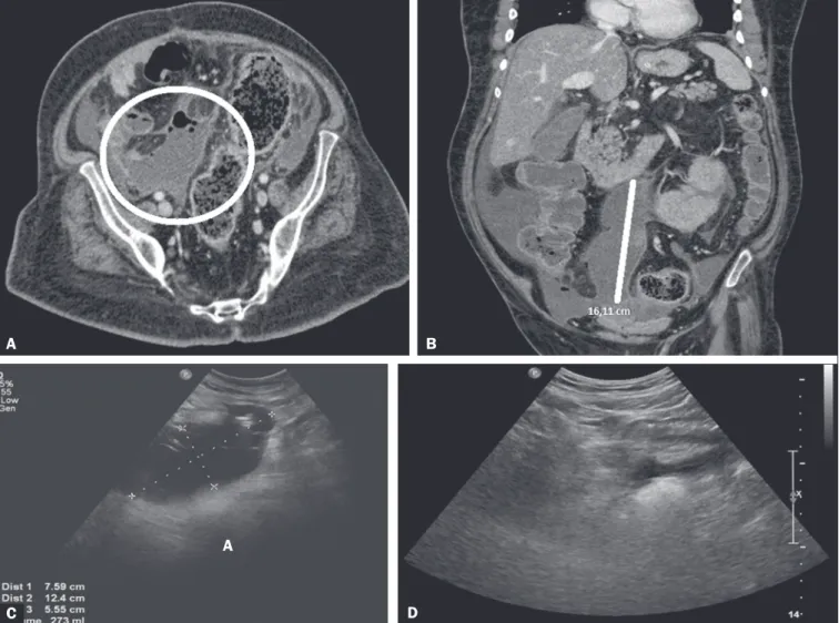 Figure 1. A,B: Computed tomography showing an intraperitoneal collection. C: Ultrasound six days after drainage of the collection, showing septa prior to r-TPA  injection