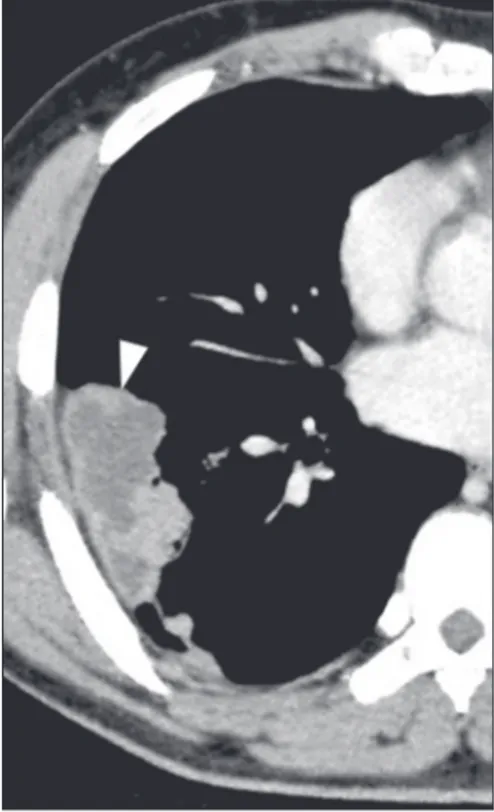 Figura 3.  Paracoccidioidomicose sem tratamento. Imagem axial de tomogra- tomogra-fia de alta resolução do tórax demonstrando múltiplos nódulos irregulares  esparsos (setas), alguns escavados (cabeças de seta).