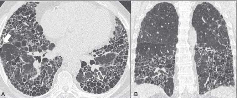 Figura 1. Fibrose pulmonar idiopática. Paciente do sexo masculino, 66 anos, tabagista