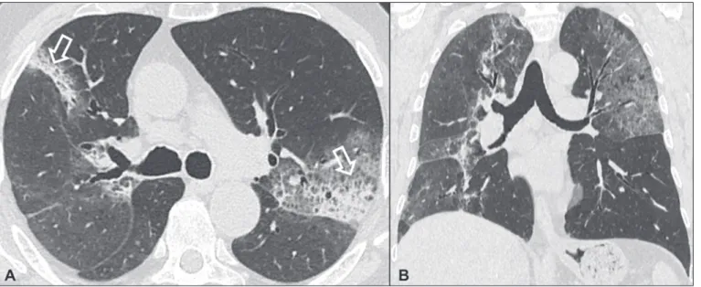 Figura 5. Pneumonia em organização. Paciente do sexo feminino, 62 anos, com dispneia há um ano e piora dos sintomas há dois meses