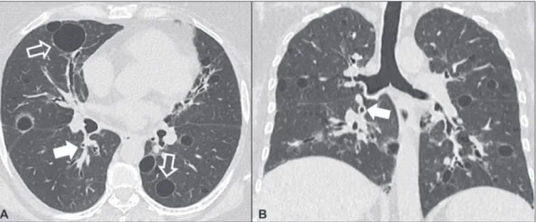 Figure 7. Lymphocytic interstitial pneumonia. A 62-year-old female patient with Sjögren’s syndrome