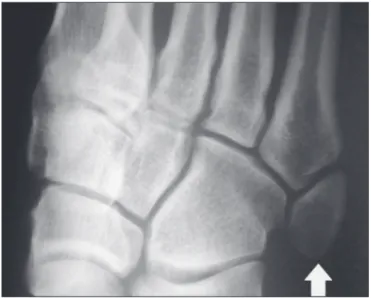 Figure 1. X-ray of the left foot (detail), in an oblique view, showing an unfused  ossicle at the base of the fifth metatarsal (arrow), with well-formed cortical  margins and apparent articulation with the base of the fifth metatarsal and  cuboid, separate