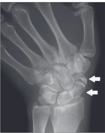 Figure 2. X-ray of the right wrist in ulnar deviation showing a divided scaph- scaph-oid (arrows) in the distal third