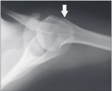 Figure 5. Axillary X-ray view showing a triangular ossicle distal to the acro- acro-mion (arrow), separated by a line of uniform thickness, consistent with os  acromiale.