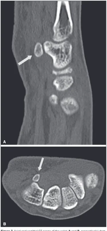 Figure 7. Axial and sagittal CT scans of the wrist (A and B, respectively) dem- dem-onstrating, at the level of the hamate, a separation from its hamulus, with  rounded and regular contours, suggestive of os hamuli proprium (arrows).