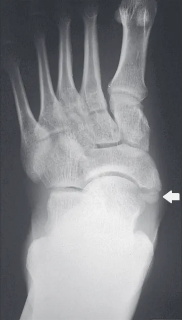 Figure 8. Anteroposterior X-ray of the left foot showing a triangular ossicle  posteromedial to the navicular bone (arrow), with regular margins and  appar-ent articulation with the navicular bone, consistappar-ent with a type 2 navicular  accessory bone.