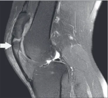 Figure 10. Sagittal T2-weighted MRI scan of the knee showing a bone frag- frag-ment in the lower portion of the patella (arrow), next to the patellar tendon  insertion, containing a discrete signal increase suggestive of inflammatory  activity, consistent 