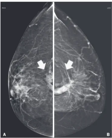 Figure 4.   Mammogram,  in  mediolateral  oblique  views,  of  a  57-year-old  fe- fe-male patient presenting with an increase and accentuation of the trabecular  breast tissue, accompanied by diffuse bilateral thickening of the skin